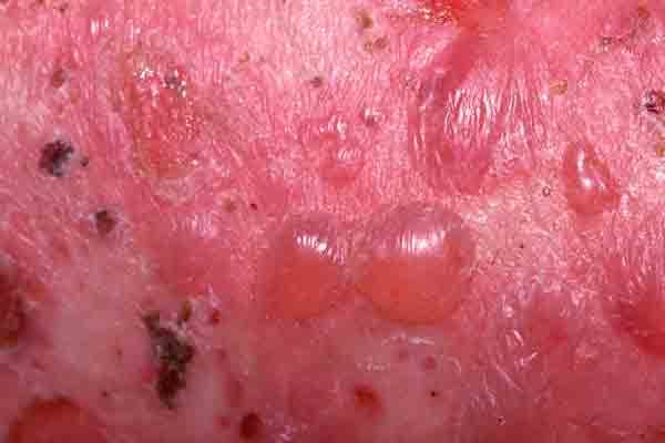 Bullous Pemphigoid