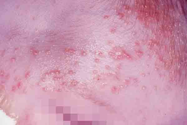 Folliculitis