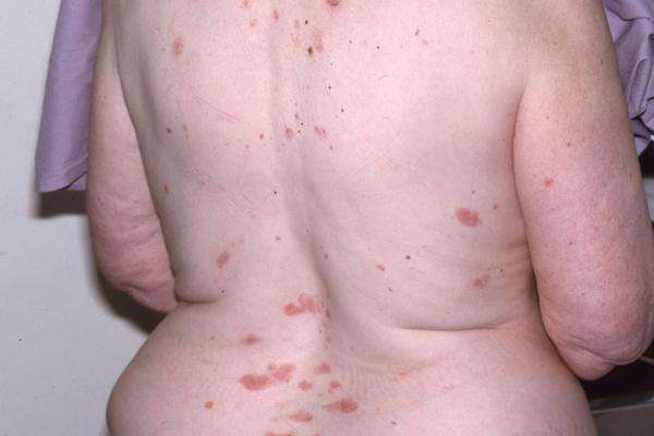 Pemphigus
