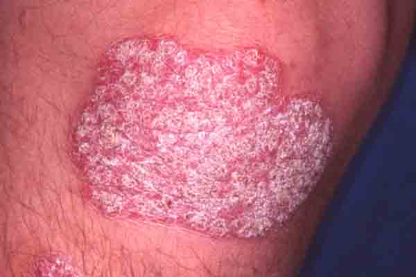 Psoriasis