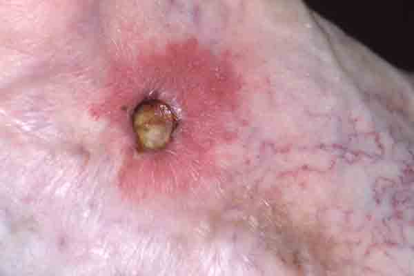 Pyoderma Gangrenosum