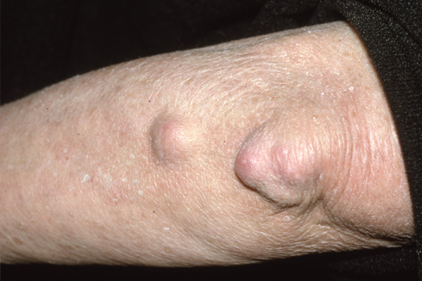 Rheumatoid Nodules