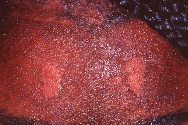 Seborrheic Dermatitis
