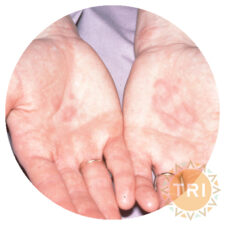 Urticaria
