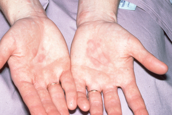 Urticaria
