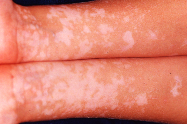 Vitiligo